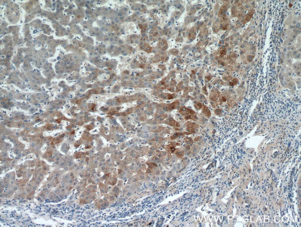 Immunohistochemistry (IHC) staining of human hepatocirrhosis tissue using FAM101A Polyclonal antibody (21113-1-AP)