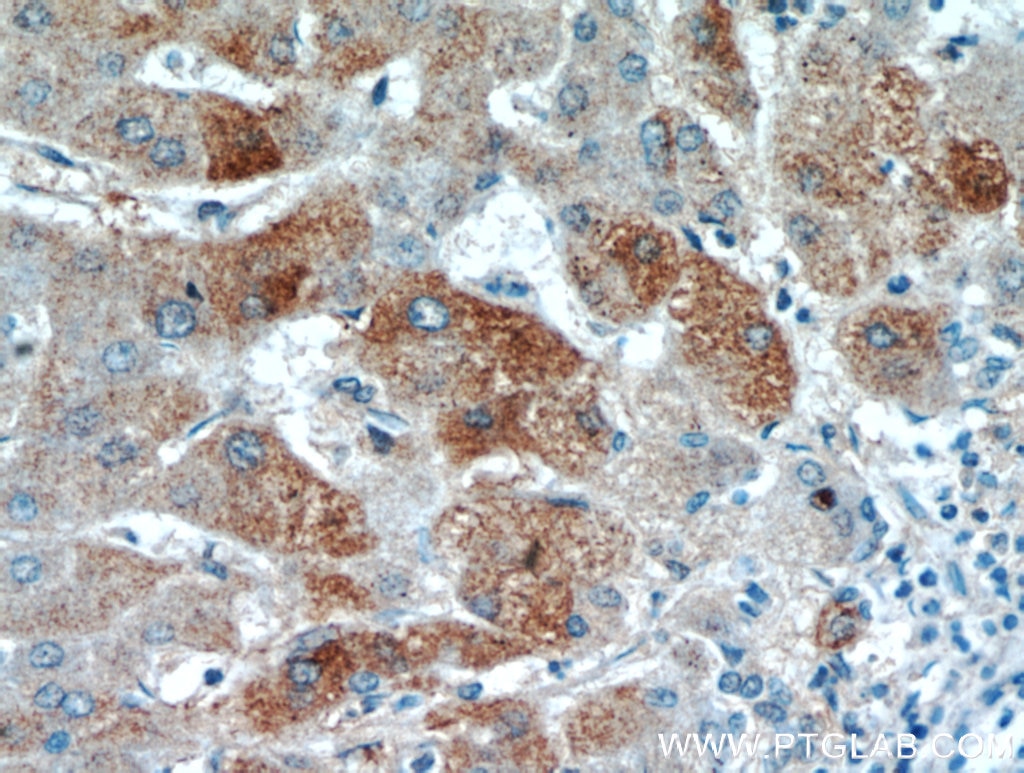 Immunohistochemistry (IHC) staining of human hepatocirrhosis tissue using FAM101A Polyclonal antibody (21113-1-AP)