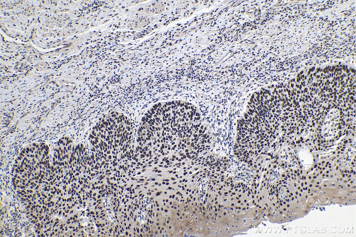 Immunohistochemistry (IHC) staining of human oesophagus cancer tissue using FAM103A1 Polyclonal antibody (19422-1-AP)