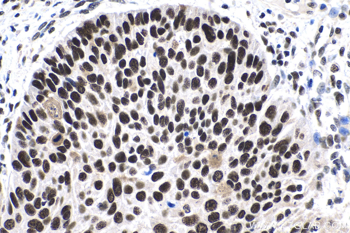 Immunohistochemistry (IHC) staining of human oesophagus cancer tissue using FAM103A1 Polyclonal antibody (19422-1-AP)