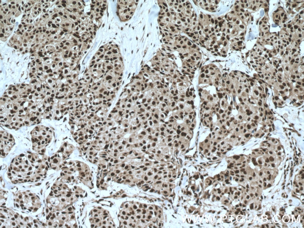 Immunohistochemistry (IHC) staining of human lung cancer tissue using FAM107A Polyclonal antibody (12176-1-AP)