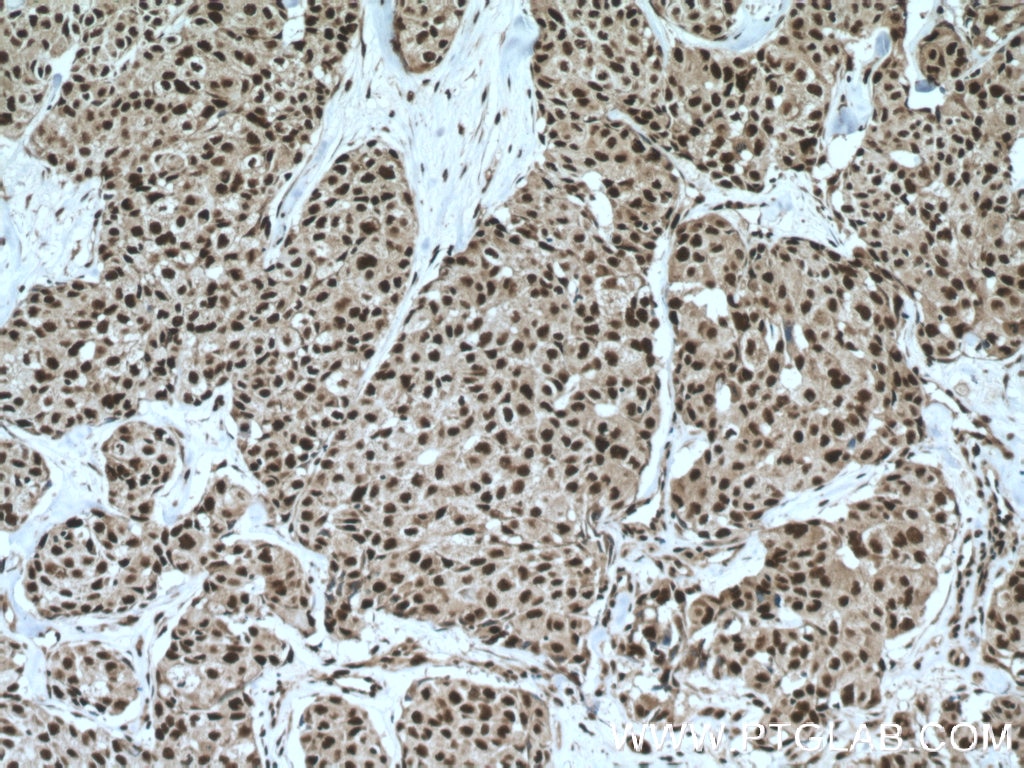 IHC staining of human lung cancer using 12176-1-AP