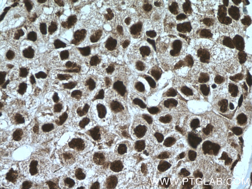 Immunohistochemistry (IHC) staining of human lung cancer tissue using FAM107A Polyclonal antibody (12176-1-AP)