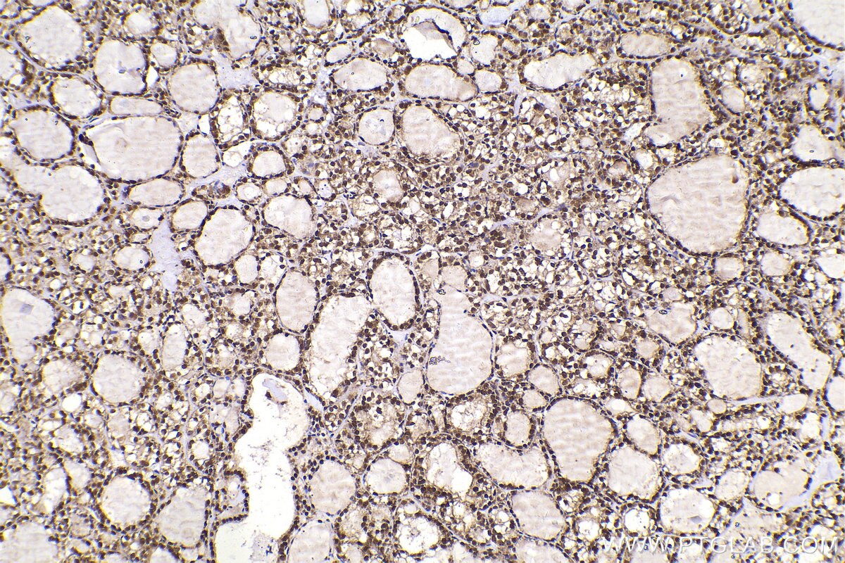 Immunohistochemistry (IHC) staining of human thyroid cancer tissue using FAM107A Polyclonal antibody (12176-1-AP)