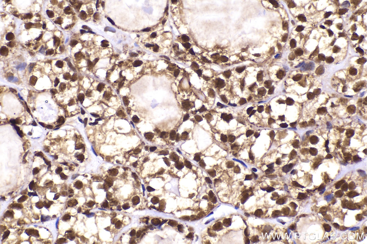 Immunohistochemistry (IHC) staining of human thyroid cancer tissue using FAM107A Polyclonal antibody (12176-1-AP)