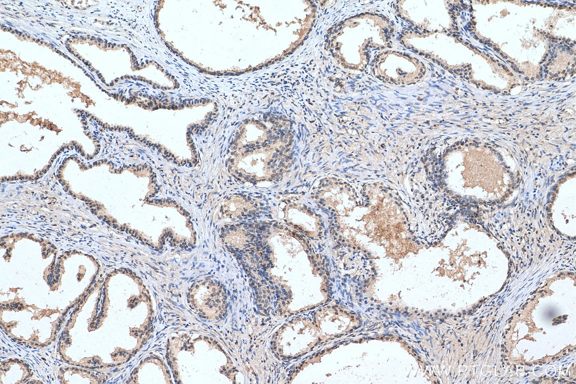 Immunohistochemistry (IHC) staining of human prostate cancer tissue using FAM111B Polyclonal antibody (29407-1-AP)