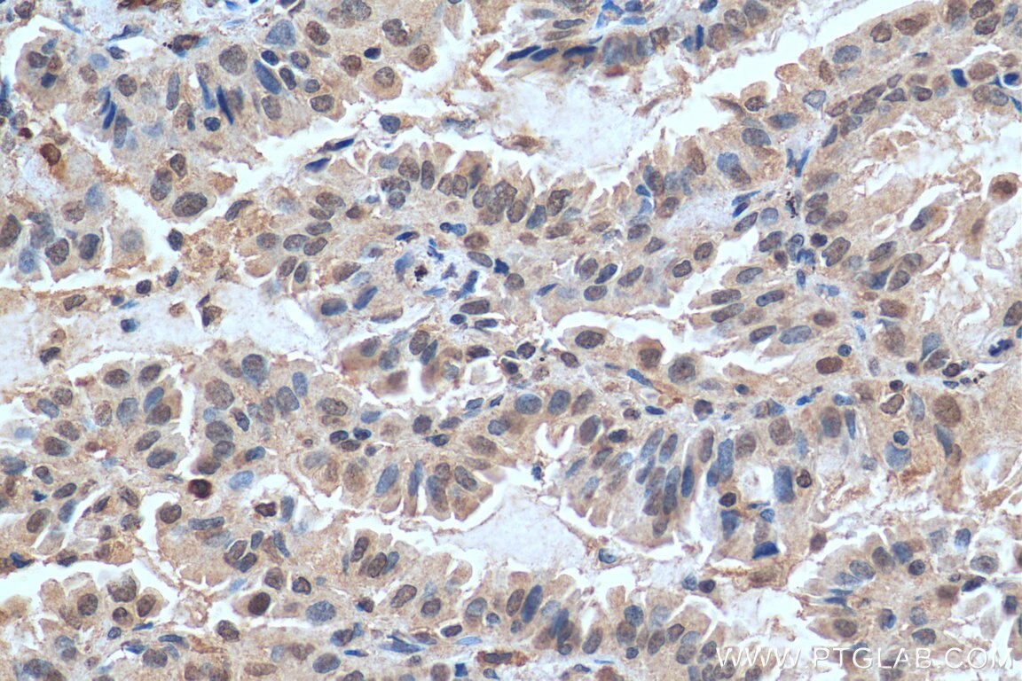 Immunohistochemistry (IHC) staining of human lung cancer tissue using FAM111B Polyclonal antibody (29407-1-AP)