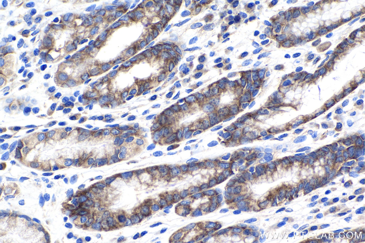 Immunohistochemistry (IHC) staining of human stomach cancer tissue using FAM120A Polyclonal antibody (21529-1-AP)