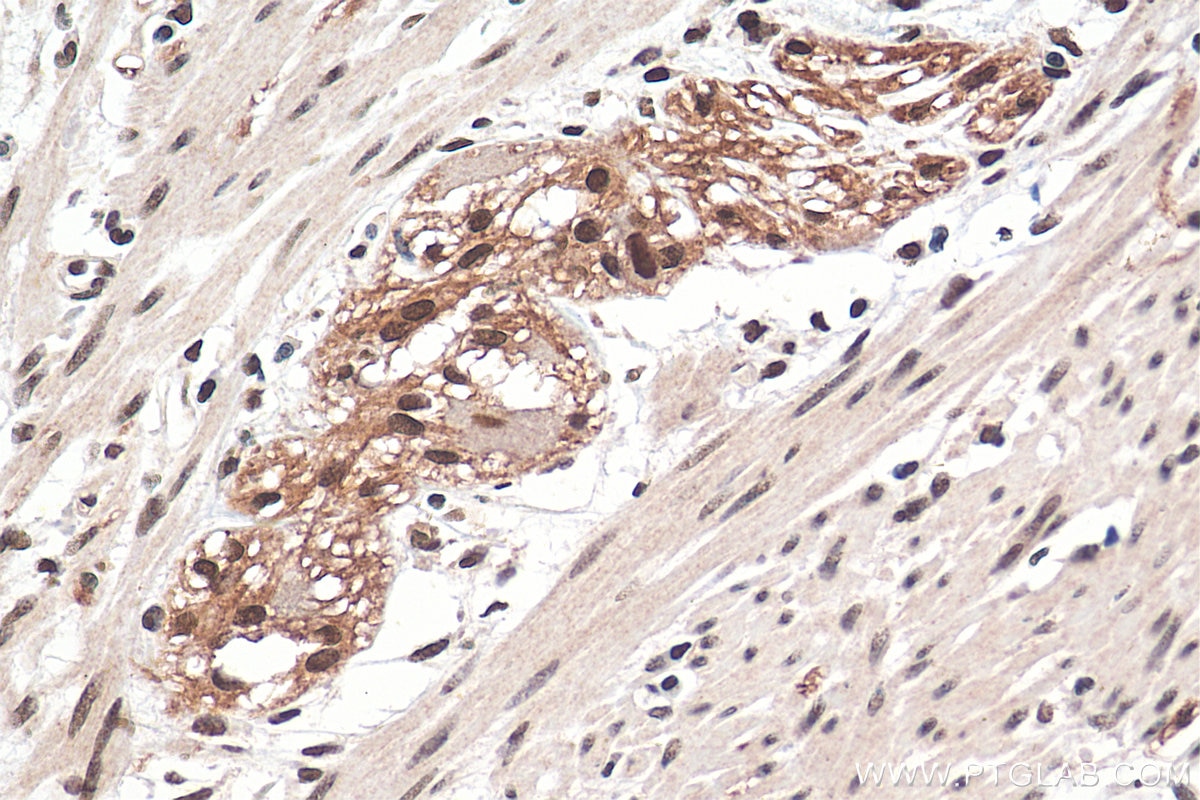 Immunohistochemistry (IHC) staining of human colon cancer tissue using FAM124B Polyclonal antibody (21313-1-AP)