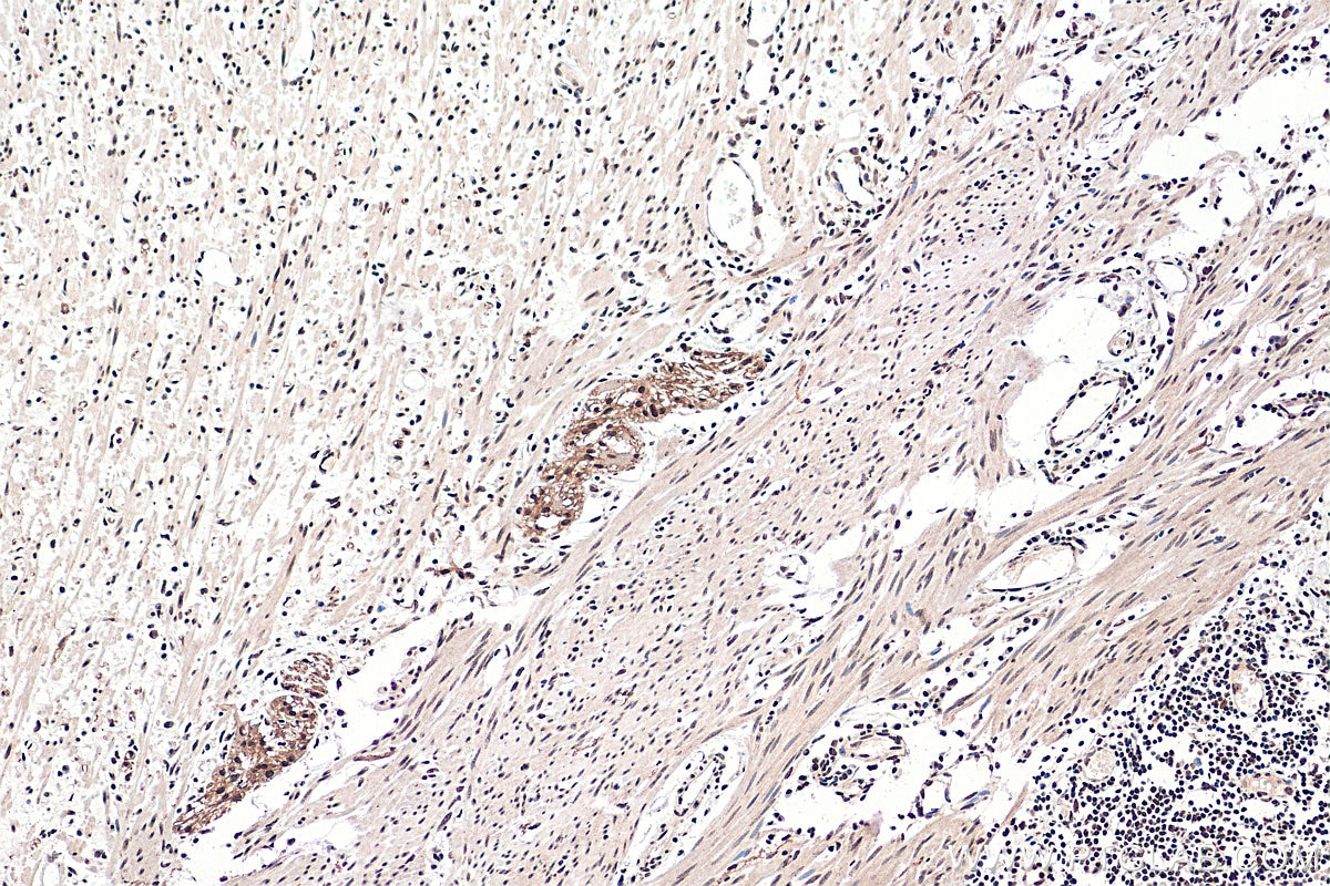 Immunohistochemistry (IHC) staining of human colon cancer tissue using FAM124B Polyclonal antibody (21313-1-AP)