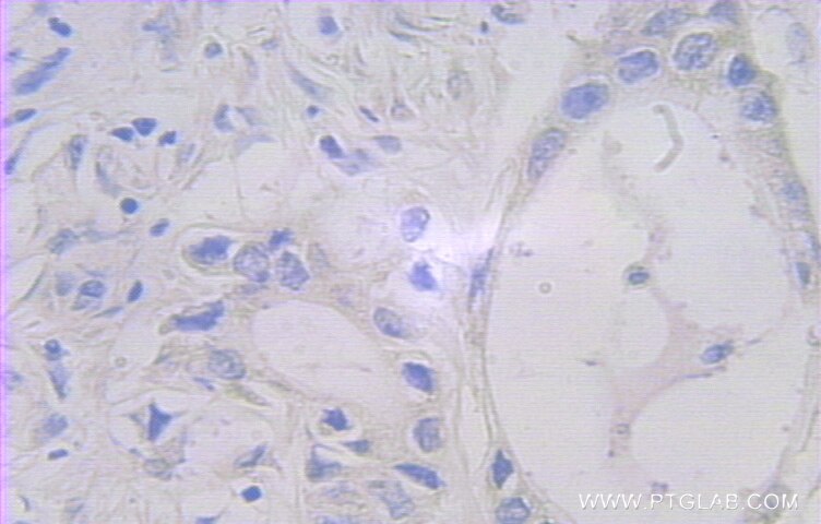 Immunohistochemistry (IHC) staining of human pancreas cancer tissue using FAM127A Polyclonal antibody (10307-1-AP)