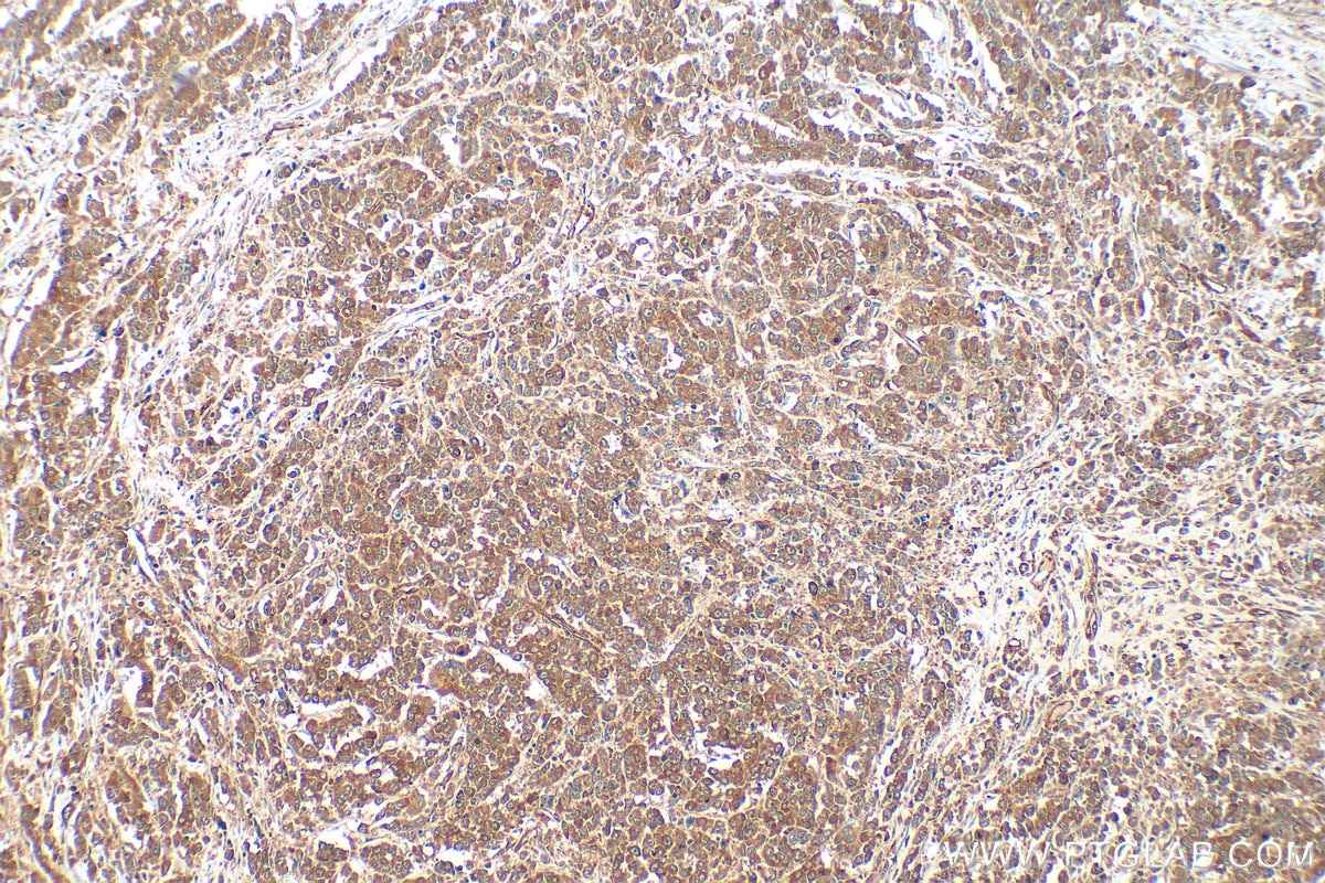 Immunohistochemistry (IHC) staining of human colon cancer tissue using FAM127 Polyclonal antibody (20282-1-AP)