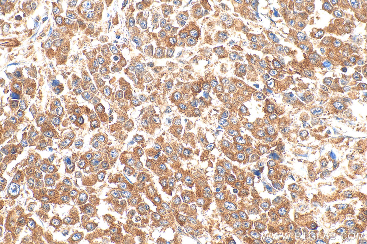 Immunohistochemistry (IHC) staining of human colon cancer tissue using FAM127 Polyclonal antibody (20282-1-AP)