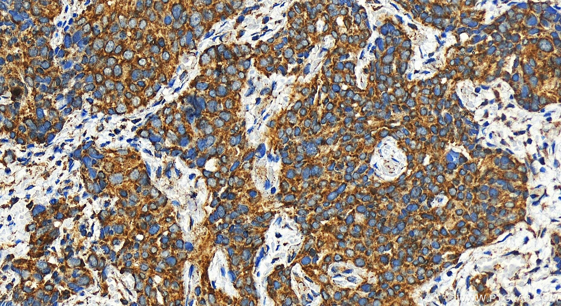 Immunohistochemistry (IHC) staining of human ovary cancer tissue using FAM136A Polyclonal antibody (30845-1-AP)