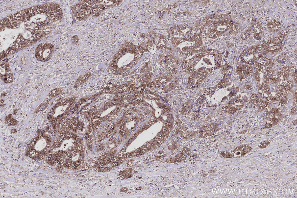 Immunohistochemistry (IHC) staining of human pancreas cancer tissue using FAM13A Polyclonal antibody (55401-1-AP)