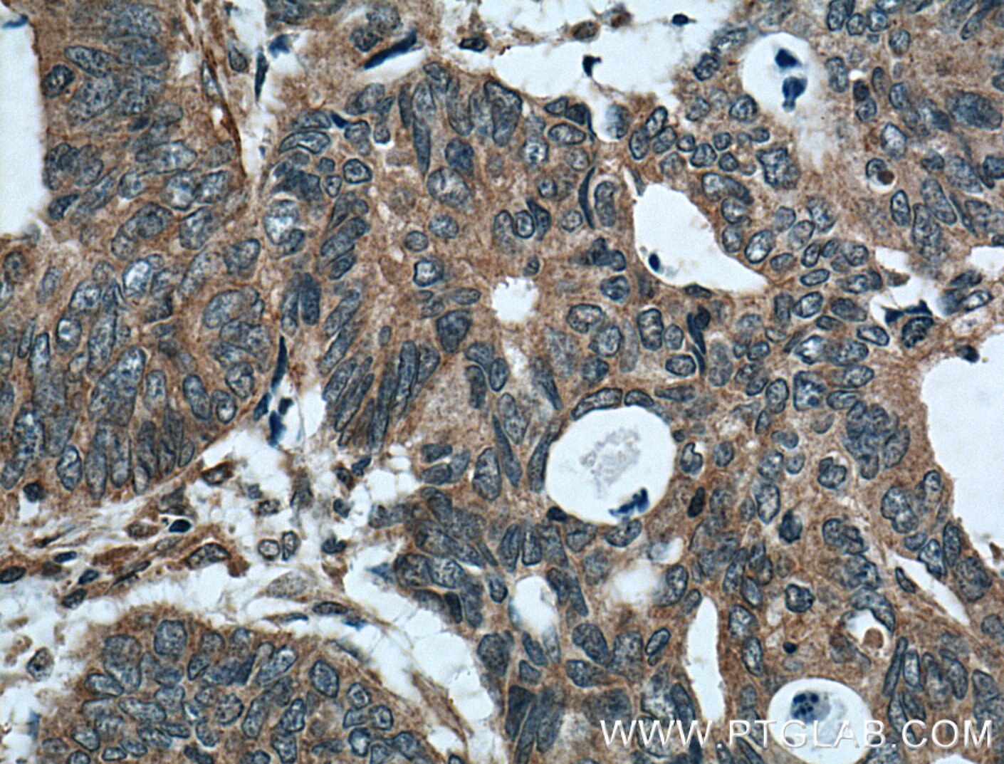 Immunohistochemistry (IHC) staining of human colon cancer tissue using FAM155A Polyclonal antibody (24929-1-AP)