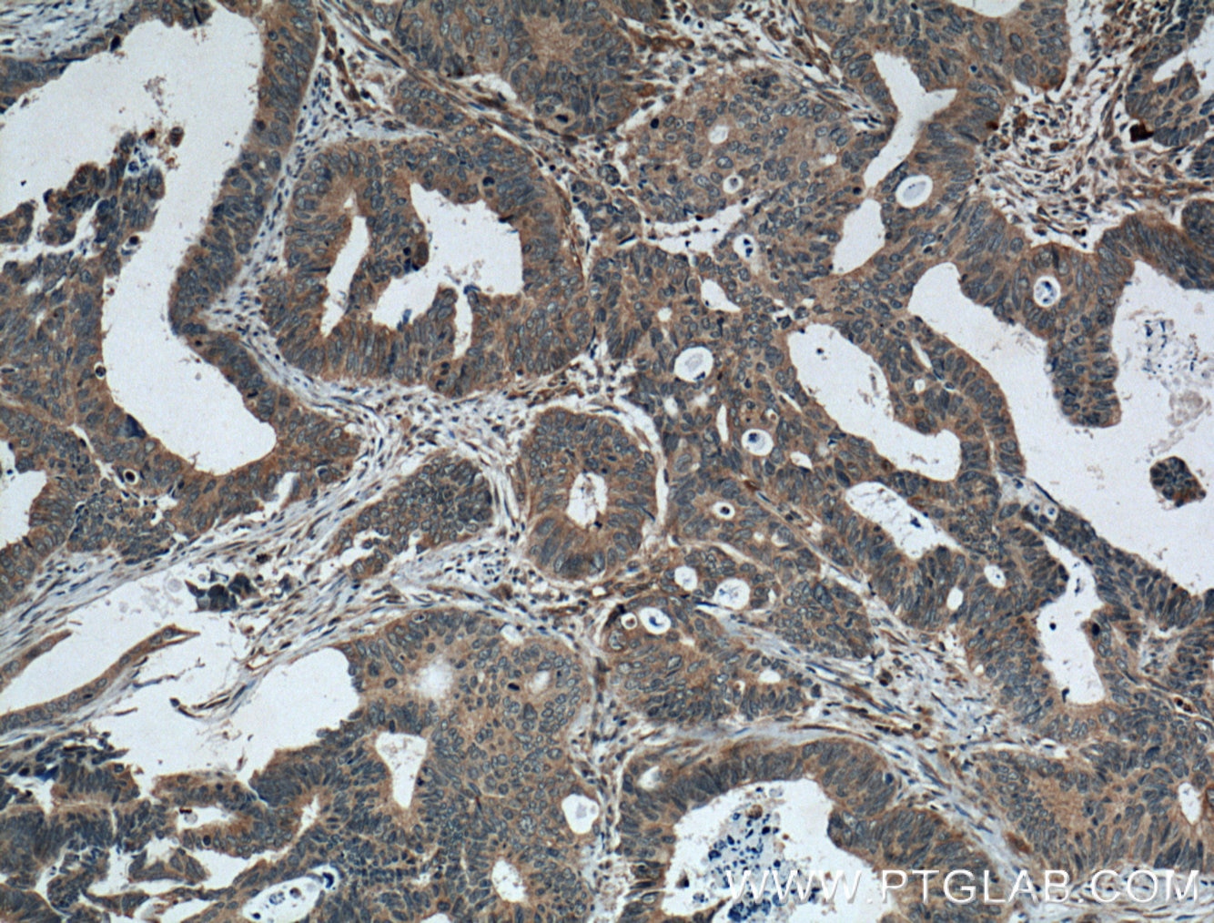 Immunohistochemistry (IHC) staining of human colon cancer tissue using FAM155A Polyclonal antibody (24929-1-AP)