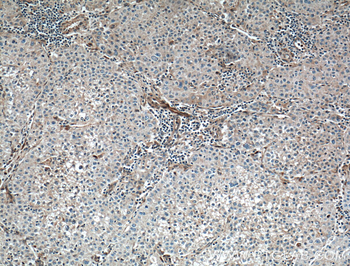 Immunohistochemistry (IHC) staining of human liver cancer tissue using FAM155A Polyclonal antibody (24929-1-AP)