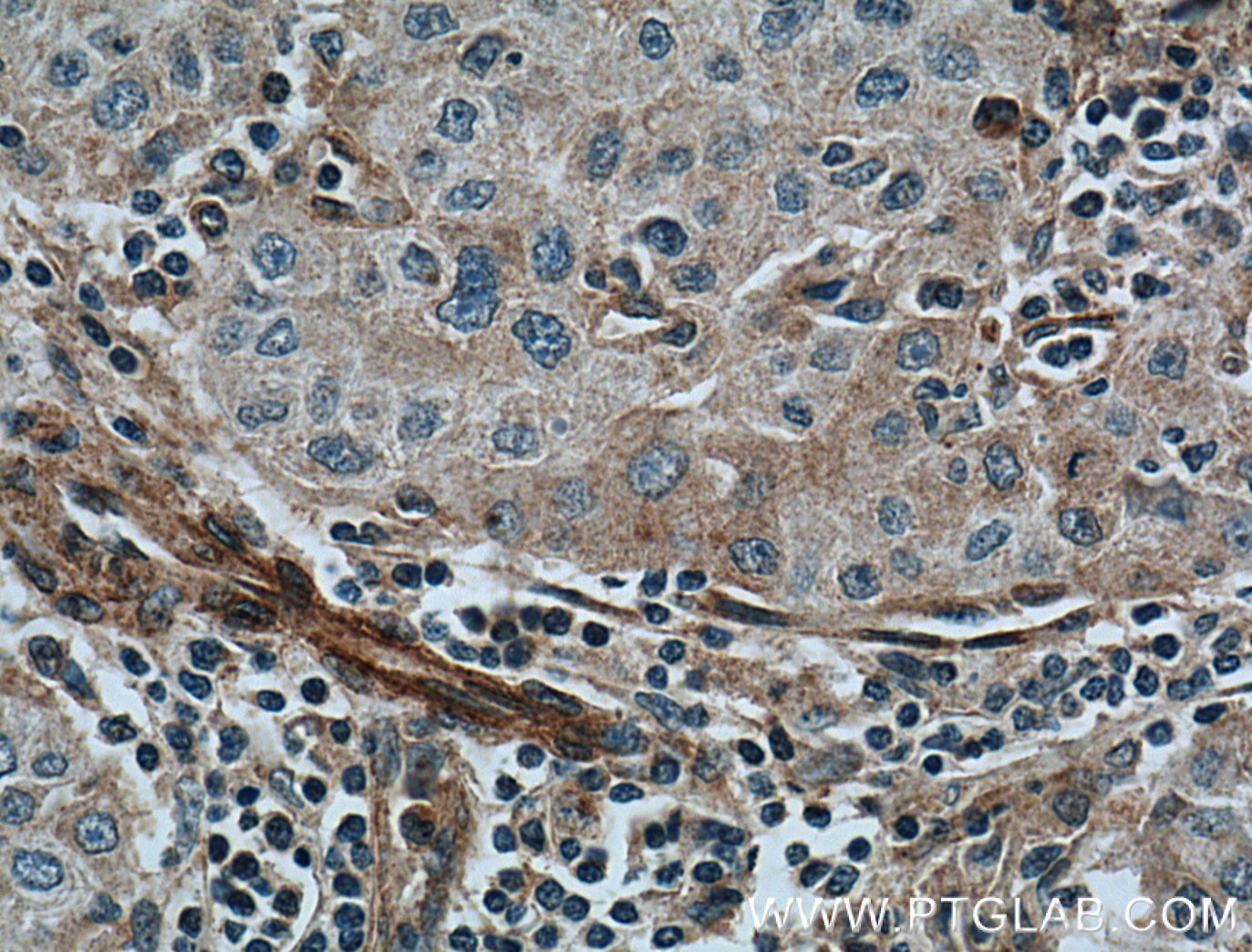 Immunohistochemistry (IHC) staining of human liver cancer tissue using FAM155A Polyclonal antibody (24929-1-AP)