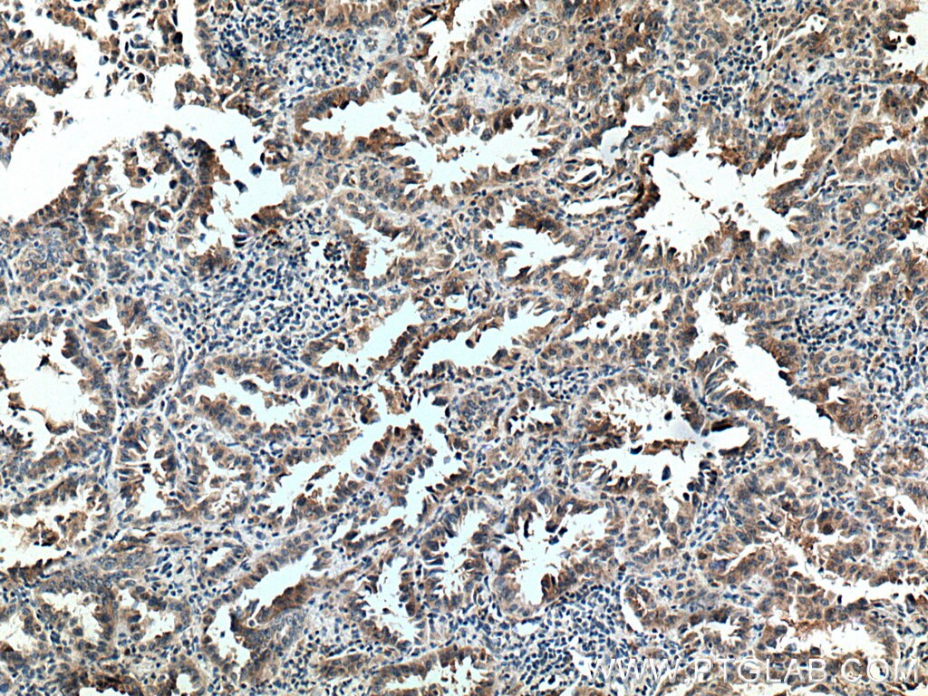 Immunohistochemistry (IHC) staining of human lung cancer tissue using FAM156A Polyclonal antibody (16914-1-AP)