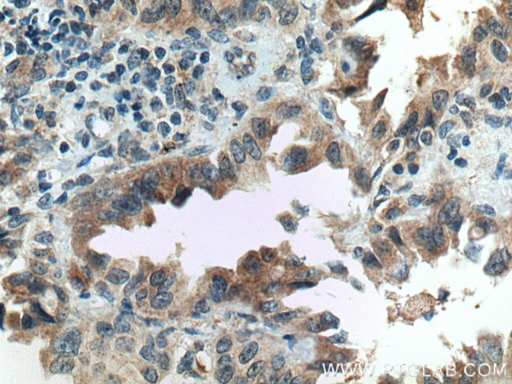 Immunohistochemistry (IHC) staining of human lung cancer tissue using FAM156A Polyclonal antibody (16914-1-AP)