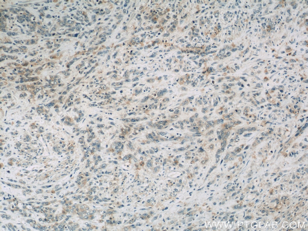 Immunohistochemistry (IHC) staining of human stomach cancer tissue using FAM168B Polyclonal antibody (24422-1-AP)