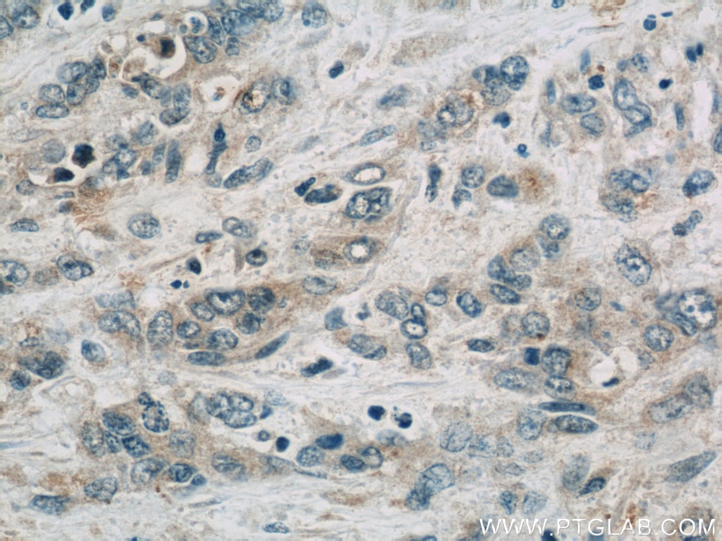 Immunohistochemistry (IHC) staining of human stomach cancer tissue using FAM168B Polyclonal antibody (24422-1-AP)