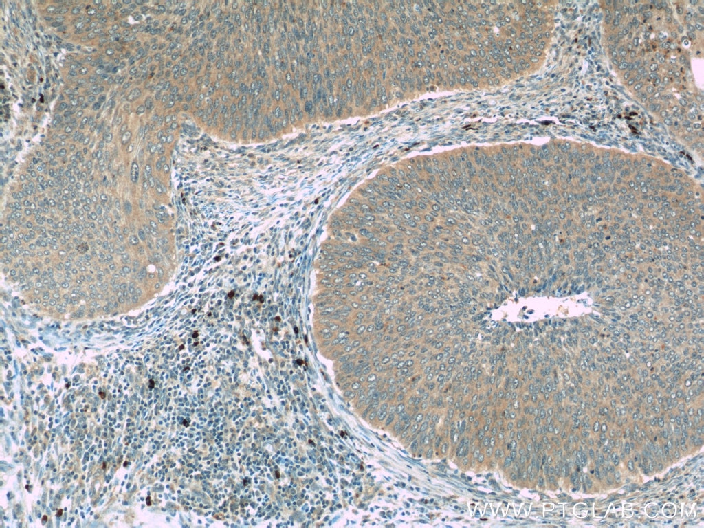 IHC staining of human cervical cancer using 24422-1-AP