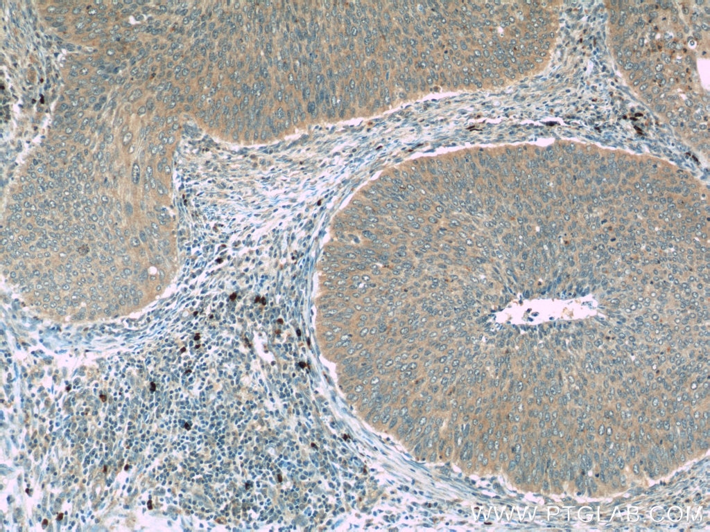 Immunohistochemistry (IHC) staining of human cervical cancer tissue using FAM168B Polyclonal antibody (24422-1-AP)