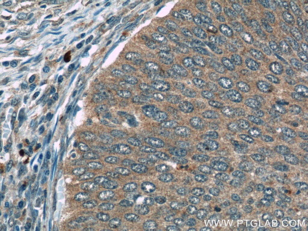 Immunohistochemistry (IHC) staining of human cervical cancer tissue using FAM168B Polyclonal antibody (24422-1-AP)
