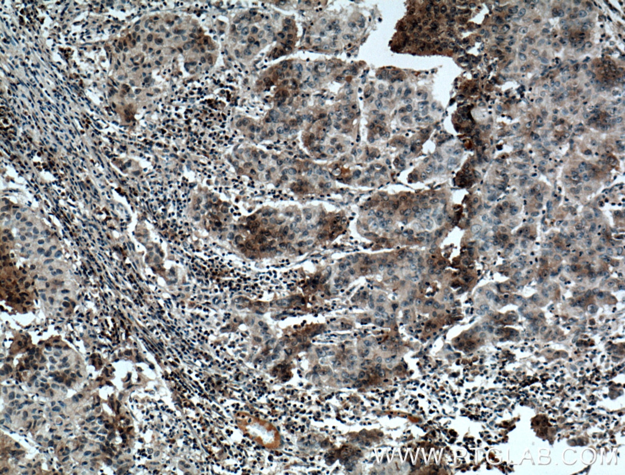 Immunohistochemistry (IHC) staining of human prostate cancer tissue using FAM174A Polyclonal antibody (24802-1-AP)