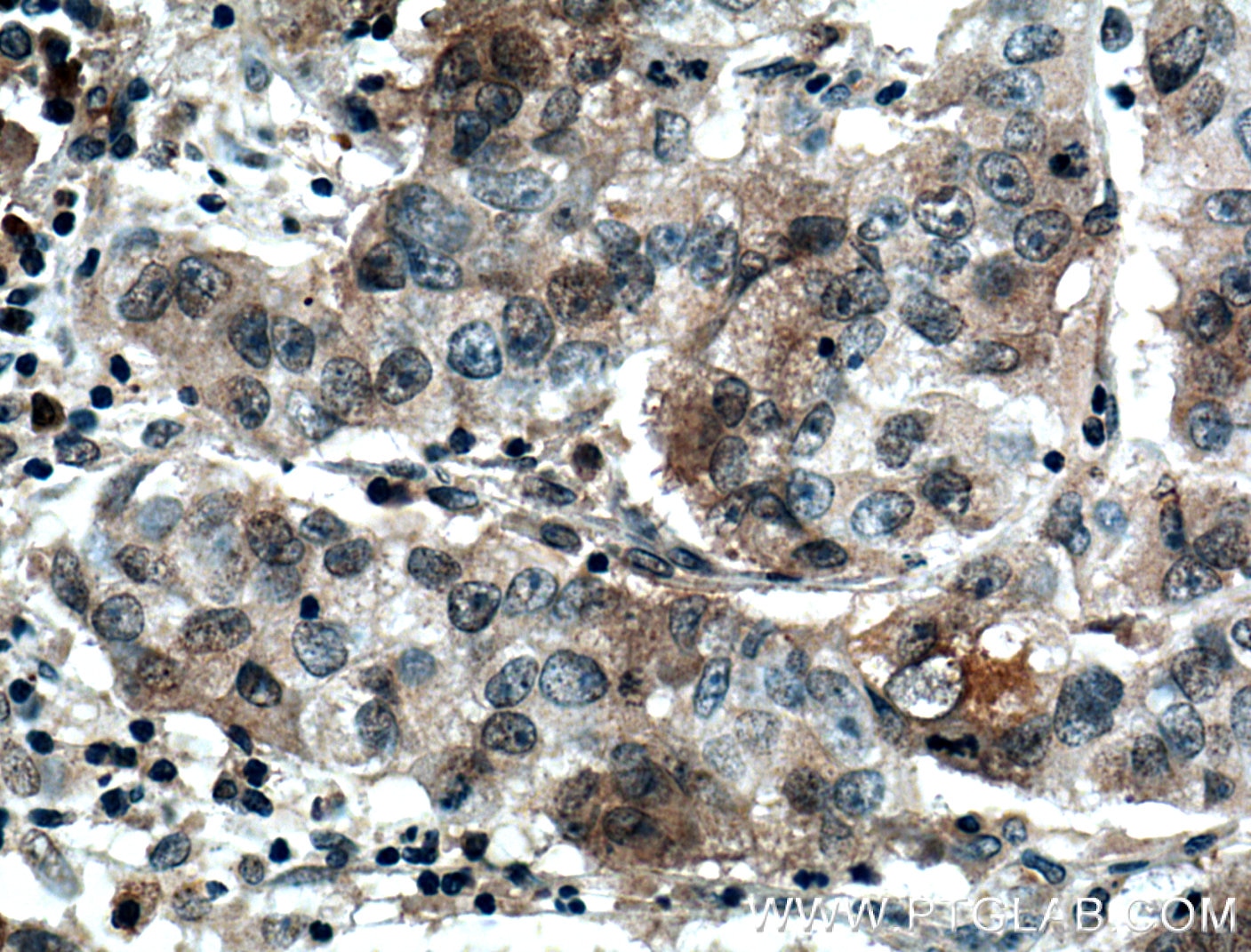 Immunohistochemistry (IHC) staining of human prostate cancer tissue using FAM174A Polyclonal antibody (24802-1-AP)