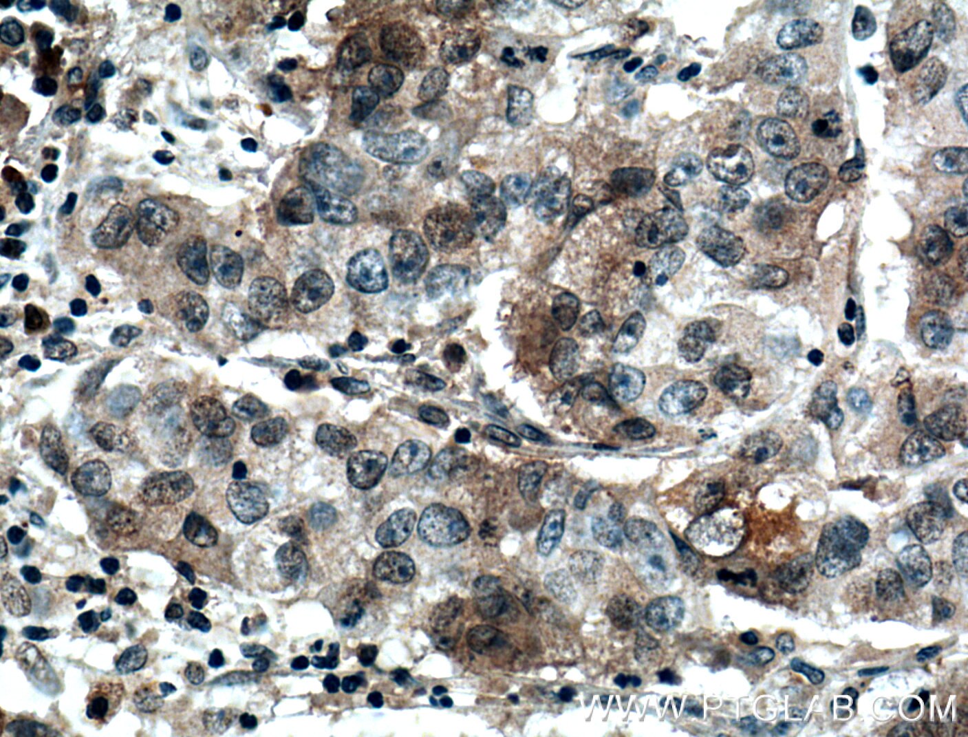 Immunohistochemistry (IHC) staining of human prostate cancer tissue using FAM174A Polyclonal antibody (24802-1-AP)