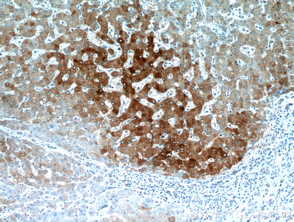 Immunohistochemistry (IHC) staining of human hepatocirrhosis tissue using FAM185A Polyclonal antibody (20911-1-AP)