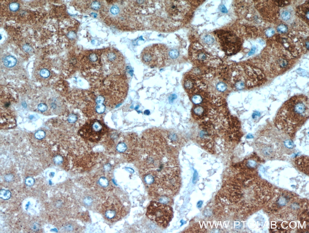 Immunohistochemistry (IHC) staining of human hepatocirrhosis tissue using FAM185A Polyclonal antibody (20911-1-AP)