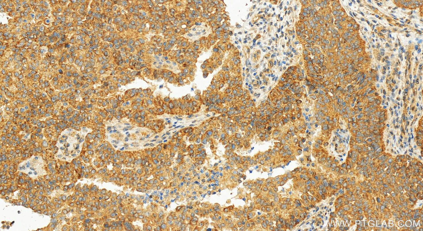Immunohistochemistry (IHC) staining of human ovarian  cancer using FAM185A Recombinant antibody (83921-3-RR)