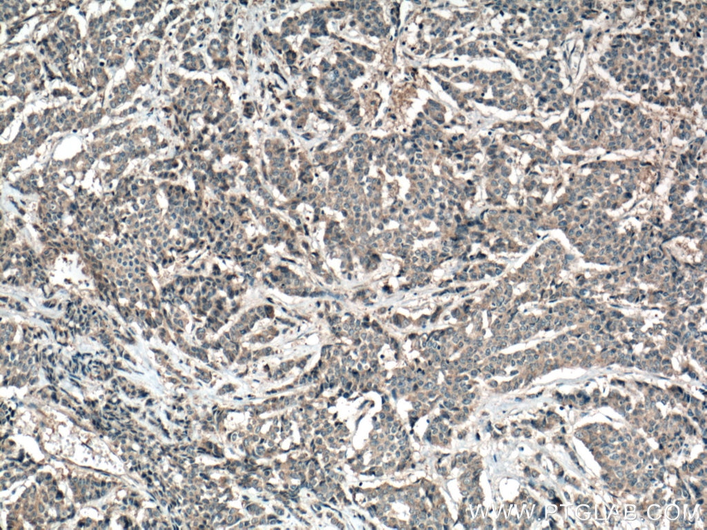 Immunohistochemistry (IHC) staining of human colon cancer tissue using FAM20A Polyclonal antibody (25258-1-AP)