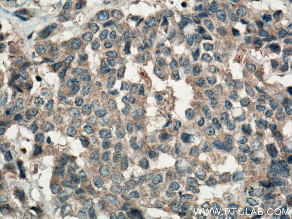 Immunohistochemistry (IHC) staining of human colon cancer tissue using FAM20A Polyclonal antibody (25258-1-AP)