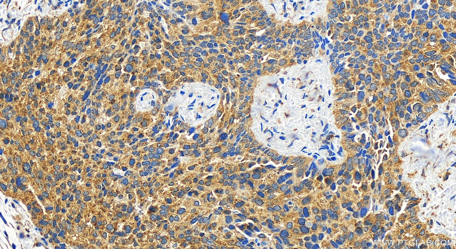 Immunohistochemistry (IHC) staining of human ovary cancer tissue using FAM210A Polyclonal antibody (31694-1-AP)