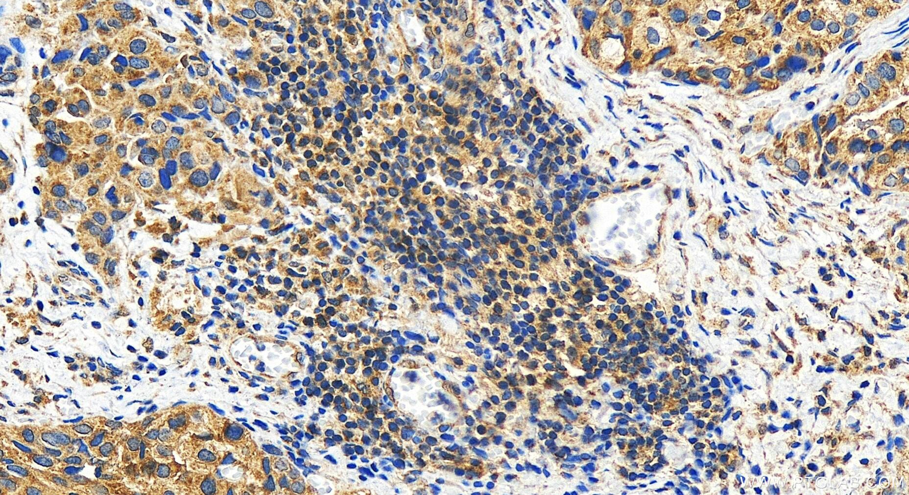 Immunohistochemistry (IHC) staining of human ovary cancer tissue using FAM210A Polyclonal antibody (31694-1-AP)