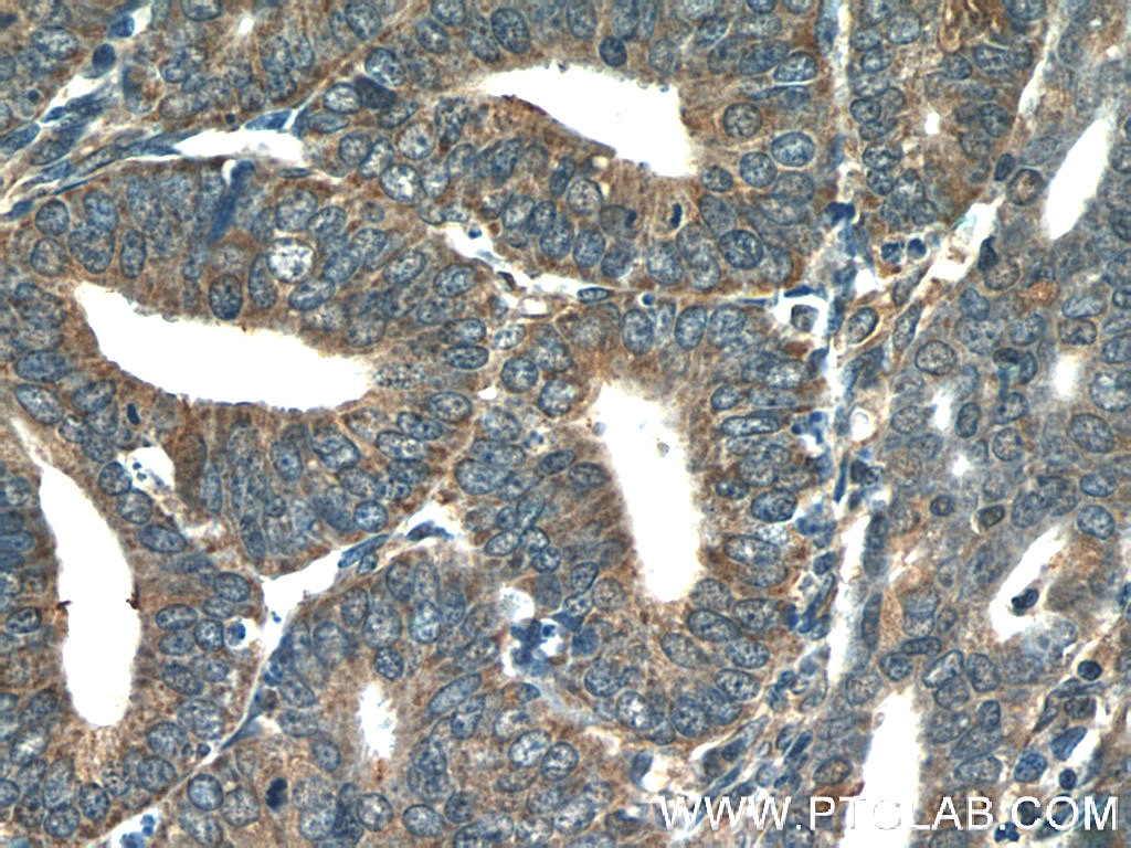IHC staining of human endometrial cancer using 25752-1-AP