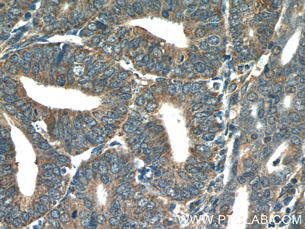 Immunohistochemistry (IHC) staining of human endometrial cancer tissue using COX20 Polyclonal antibody (25752-1-AP)