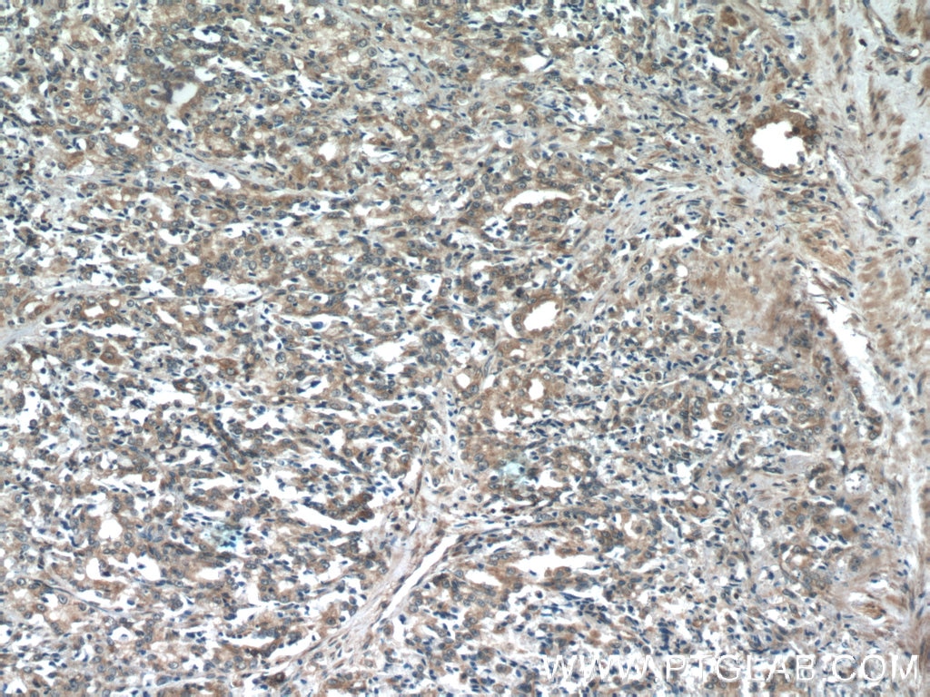 IHC staining of human prostate cancer using 25752-1-AP