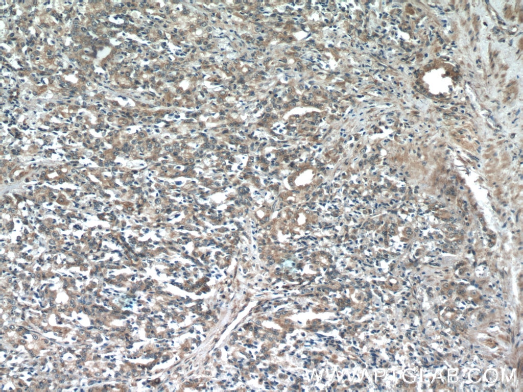 Immunohistochemistry (IHC) staining of human prostate cancer tissue using COX20 Polyclonal antibody (25752-1-AP)