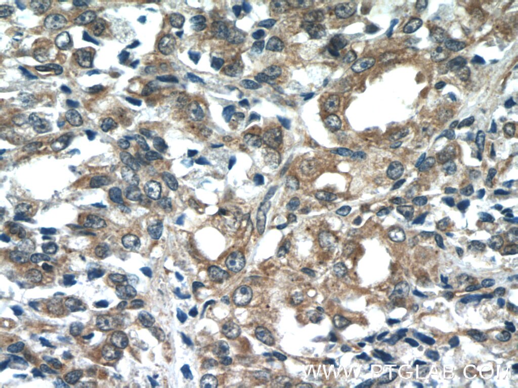 Immunohistochemistry (IHC) staining of human prostate cancer tissue using COX20 Polyclonal antibody (25752-1-AP)