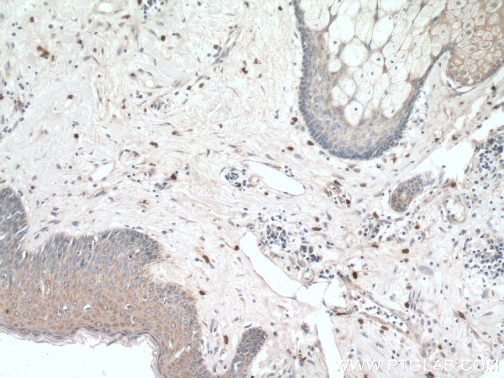 Immunohistochemistry (IHC) staining of human skin cancer tissue using Piezo1 (extracellular domain) Polyclonal antibody (15939-1-AP)