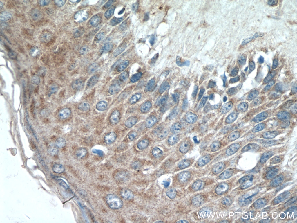 Immunohistochemistry (IHC) staining of human skin cancer tissue using Piezo1 (extracellular domain) Polyclonal antibody (15939-1-AP)