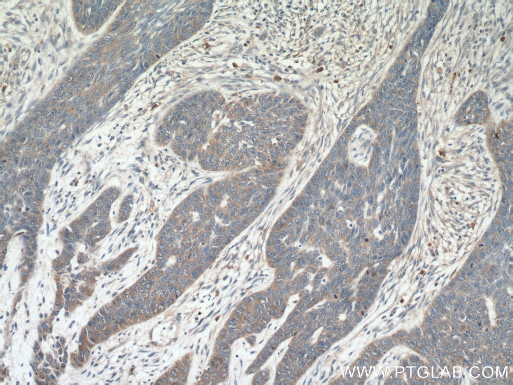 Immunohistochemistry (IHC) staining of human skin cancer tissue using Piezo1 (extracellular domain) Polyclonal antibody (15939-1-AP)
