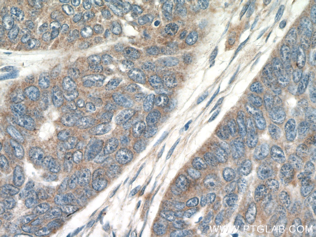 Immunohistochemistry (IHC) staining of human skin cancer tissue using Piezo1 (extracellular domain) Polyclonal antibody (15939-1-AP)