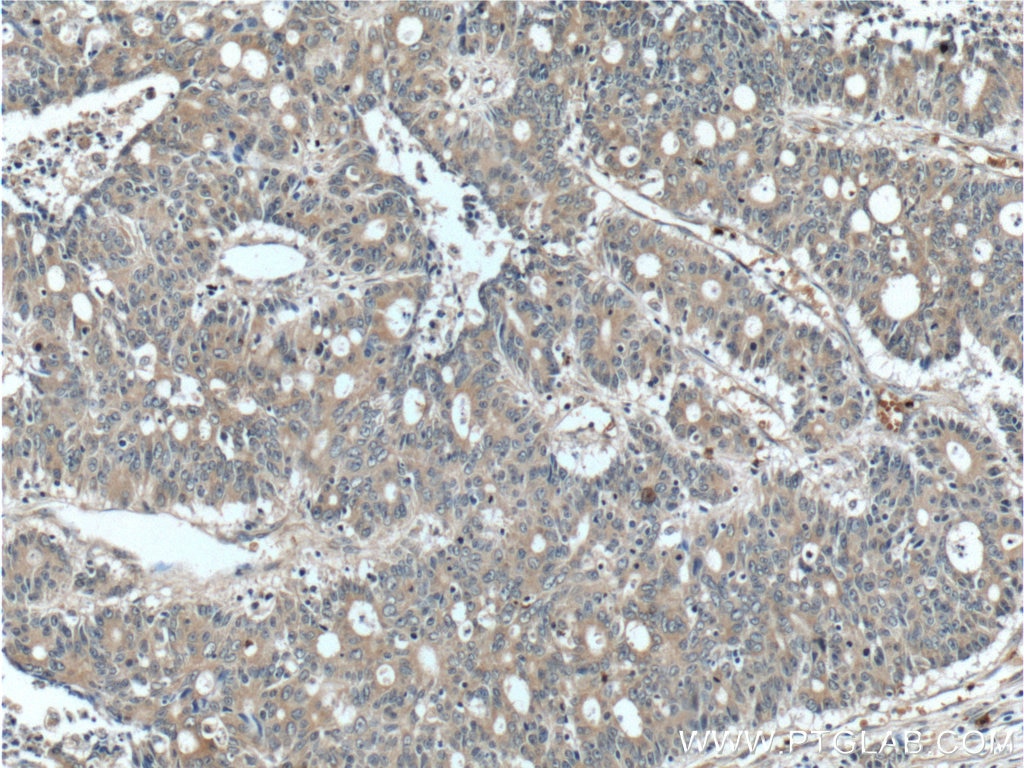 Immunohistochemistry (IHC) staining of human colon cancer tissue using FAM3B Polyclonal antibody (14043-1-AP)